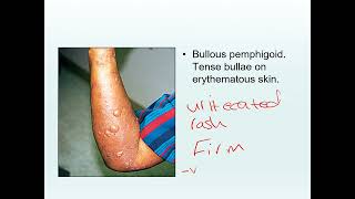 Bullous dermatosis [upl. by Enineg]