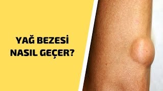 Yağ Bezesi Nasıl Geçer  Yağ Bezeleri Nasıl Tedavi Edilir  Eklem Ağrılarına Ne İyi Gelir [upl. by Ko]