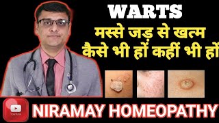 मस्से को जड़ से हटाने के उपाय  Home remedies for warts 100 effective [upl. by Alva]