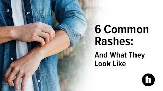 6 Common Rashes And What They Look Like  Healthline [upl. by Imik]