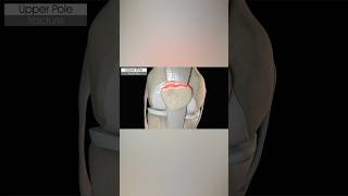 Upper Pole Patella Fracture medicalanimation health [upl. by Samantha]