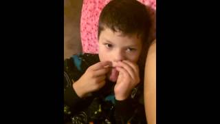 Angelman Syndrome  Constantly rubbing his face  side effects [upl. by Sokram]