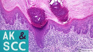 Squamous Cell Carcinoma amp Actinic Keratosis 101Dermpath Basics amp Beyond [upl. by Dnomasor]