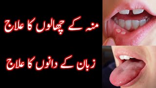 Muh ke chalon ka ilaj  Zuban ke dano ka ilaj  Mouth blisters treatment at home  Wekho Punjab [upl. by Brock]