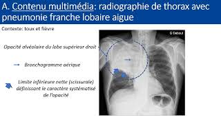 Item 154 Pneumopathie aigue communautaire [upl. by Eintihw]