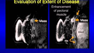 UCSF Radiology Mammography Images Revealing What Cancer Looks Like [upl. by Ahsiekit412]