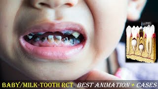 Cavity Root Canal Treatment in Kids Pulpectomy Best Animation of RCT in MilkBabyPrimary Teeth [upl. by Sadonia]