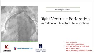 Right ventricle perforation in catheter directed thrombolysis CDT of pulmonary artery [upl. by Swec]