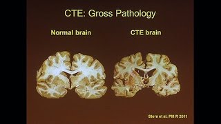 Chronic Traumatic Encephalopathy [upl. by Merrow1]