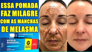 ACABE COM MELASMA E MANCHAS DE ACNE EM POUCOS DIAS COM ESSA POMADA MILAGROSA [upl. by Ynnahc390]