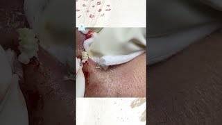 Big Cystic Acne Blackheads Extraction Blackheads amp Milia Whiteheads Removal Pimple Popping shorts [upl. by Gnurt]