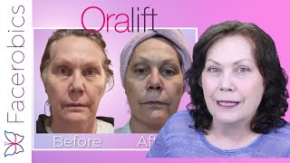 ORALIFT amp Facerobics Trial Results  See My RESULTS  I Am Thrilled [upl. by Nesyla706]