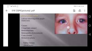 orbit Lense pupil Cataract 🔴OSPE slides diagnosis treatment opthalmology Eye ospe 4thyearmbbs [upl. by Ruscio881]