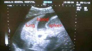 A quick diagnosis of hemothorax by ultrasound [upl. by Twila]