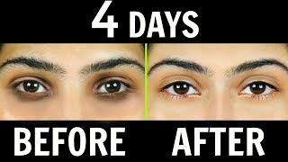 How to Remove Dark Circles Naturally in 4 Days 100 Results  Anaysa [upl. by Nailil]