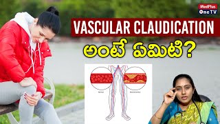 Vascular Claudication Symptoms and Treatment l Dr Niveditha Sai Chandra MedPlusONETV [upl. by Strait]