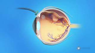 Vitrectomy Surgery for Detached Retina [upl. by Dragone]