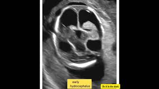 Early hydrocephalus radiology ultrasoundscans ultrasound radiography DoItInTheDark [upl. by Aisenat]