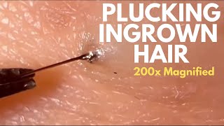 Plucking Black Long Ingrown Hair From Underneath Skin Slimy Wet Tip at 200x Magnified 毛发内生 [upl. by Calvert]