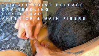 Trigger Point Release  Dry Needling Upper Trap anterior amp main fibers [upl. by Adierf]