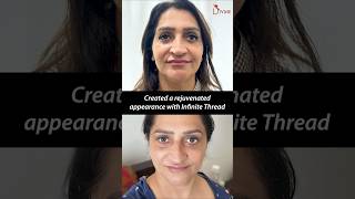 Day 2 to Week 1 Jawline Transformation and AntiAging Results with Infinite Thread Lift [upl. by Rodmun]