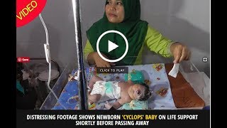 Tragic cyclops baby born with one eye after mum was exposed to mercury during pregnancy [upl. by Allehc]