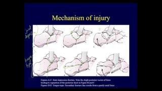 Calcaneal fractures  Anatomy evaluation classification OTA lecture series IV L15a [upl. by Harbour738]