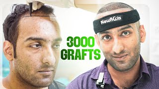 Hair Line Transplant  3000 Grafts  Hair Transplant Kolkata  New Roots [upl. by Husha35]