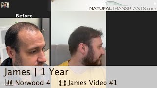 Norwood 4 Hair Transplant 1 Year PostSurgery Results  Dr Blumenthal James [upl. by Ytinirt]