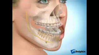 Cirurgia ortognática deformidade dentofacial classe III [upl. by Eniamurt202]