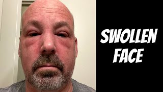 Swollen Face  Cancer Update [upl. by Wainwright769]