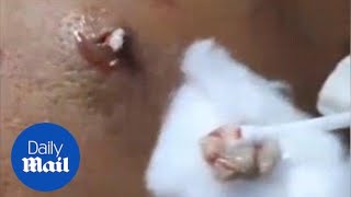 Dermatologist squeezes tenyearold spot on mans back in Hanoi [upl. by Ddot]