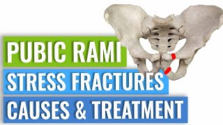 Pubic Ramus Stress Fractures Treatment [upl. by Nakre687]