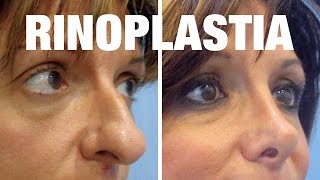 Rinoplastia Antes y Después  Tratamiento de Ana Isabel [upl. by Nevear]