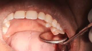 extraction of grossly decayed upper left molars [upl. by Anecusa]