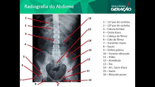 Radiografia do Abdome AP  Decúbito [upl. by Atimad]