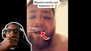 THE CYST EXPLODED IN HIS MOUTH😱  Pimple popping and Blackhead Compilation [upl. by Deyes]