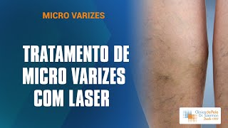 Micro Varizes Laser para o Tratamento [upl. by Mikal]