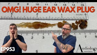 OMG HUGE EAR WAX PLUG REMOVED  EP953 [upl. by Acirretahs49]