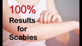 How To Get Rid Of Scabies With Natural Remedies And Scabies Treatment [upl. by Pomfret]