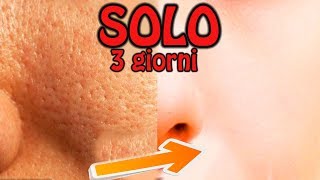 Come sbarazzarsi in modo permanente dei grandi pori dilatati e cicatrici da acne NATURALMENTE A CASA [upl. by Bently]