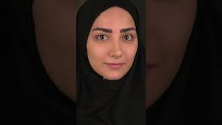 Rhinoplasty with Dr Bashartizadeh جراحی زیبایی بینی با دکتر بشارتی زاده [upl. by Etnahs669]