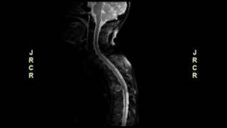 Radiology video Aggressive Adenoid Cystic Carcinoma With Asymptomatic Spinal Cord Compression [upl. by Siegler352]