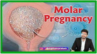 Gestational Trophoblastic Disease GTD A Case Study on Complete Molar Pregnancy by Palvinder Kaur [upl. by Latsyrhc828]