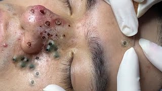 Big Cystic Acne Blackheads Extraction Blackheads amp Milia Whiteheads Removal Pimple Popping 0034💆 [upl. by Cantu]