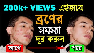 ব্রণ দূর করার উপায়  Mukher kalo dag dur korar upay  How to Remove Pimples or Acne [upl. by Garlan454]