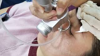 LASER CO2 FRACTIONAL TREATMENT [upl. by Enitsahc61]