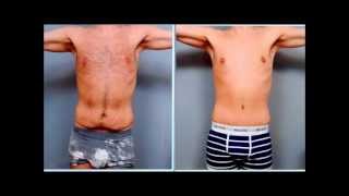 Male Tummy Tuck  Case Study  Dr Sterry [upl. by Aisel]