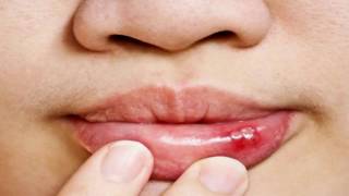 Difference Between Cold Sore and Canker Sore [upl. by Three436]