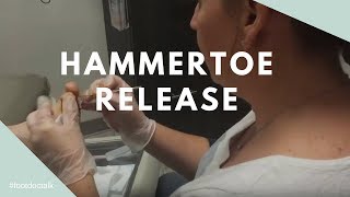 Hammertoe Tendon Release [upl. by Ahsyen]